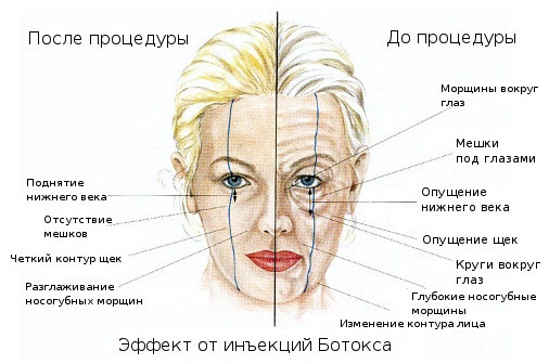 Эффект от ботокса