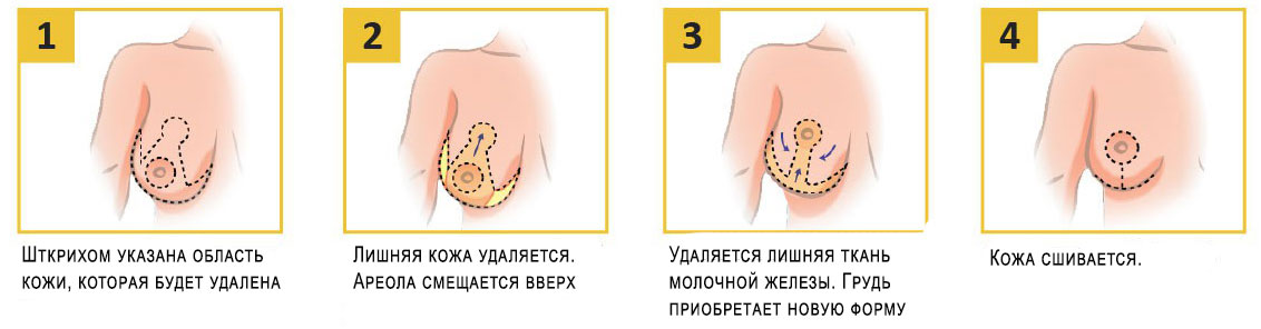 Якорный метод подтяжки груди